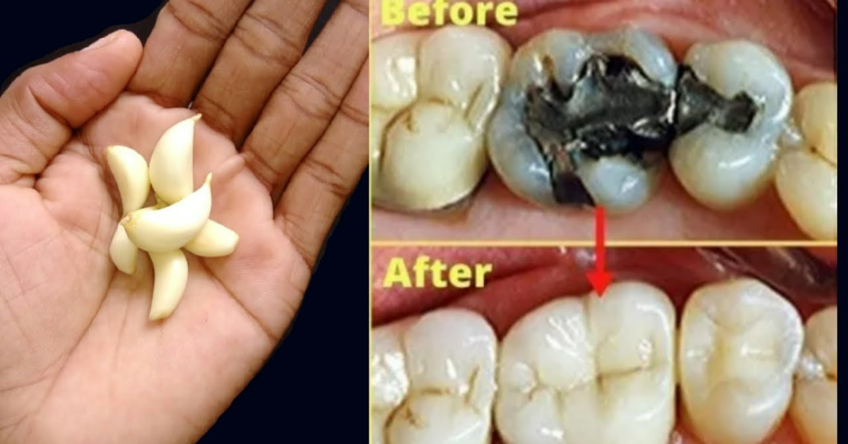 Teeth Pain Treatment at home