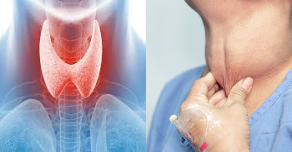 Thyroid DiseaseTreatment At Home