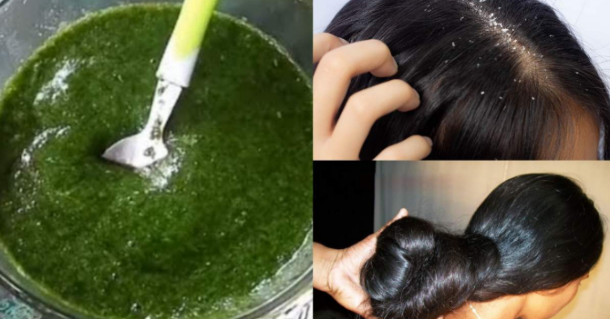 To Remove Dandruff at Home