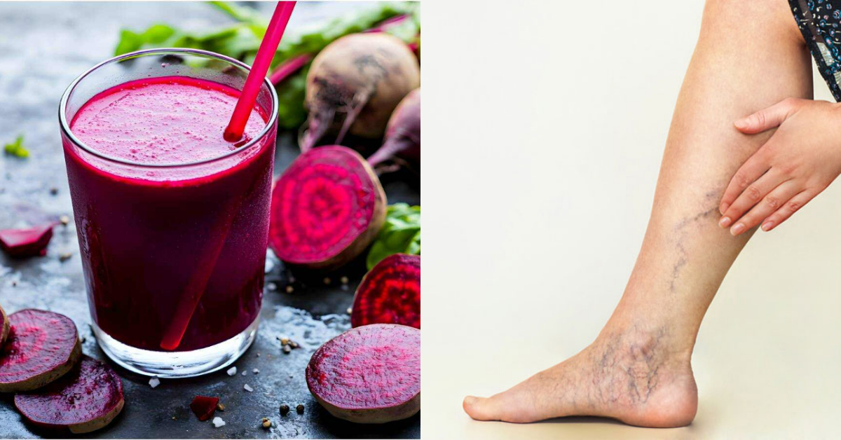 Varicose Veins Treatment At Home